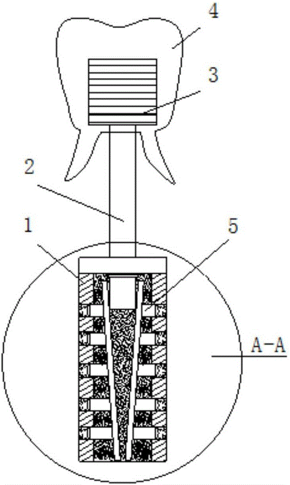 一種應(yīng)力分散型種植牙的制作方法附圖